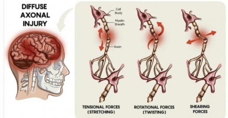 Kritis Dianiaya, Anak Kader GP Ansor Kena Diffuse Axonal Injury, Begini Penjelasannya... (Foto : Istimewa)