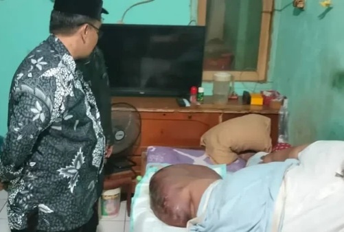 Pria di Tangerang Mengidap Limfedema-Obesitas, BB-nya 230 Kg Foto : Ist