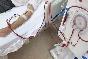 Banyak Kasus Anak Cuci Darah Kian Memicu Keprihatinan Ilustrasi cuci darah. Foto : Ist