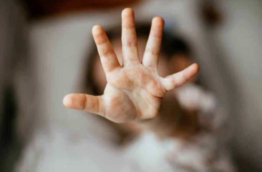 Wanita di Bojonggede Jadi Korban Penganiayaan, Dilarikan ke RS usai Disayat Pisau Cutter Foto : Ist