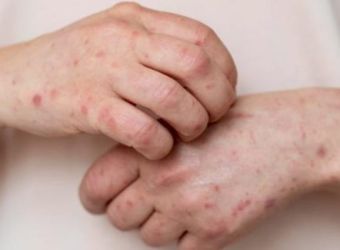 ilustrasi cacar monyet. (Ist)